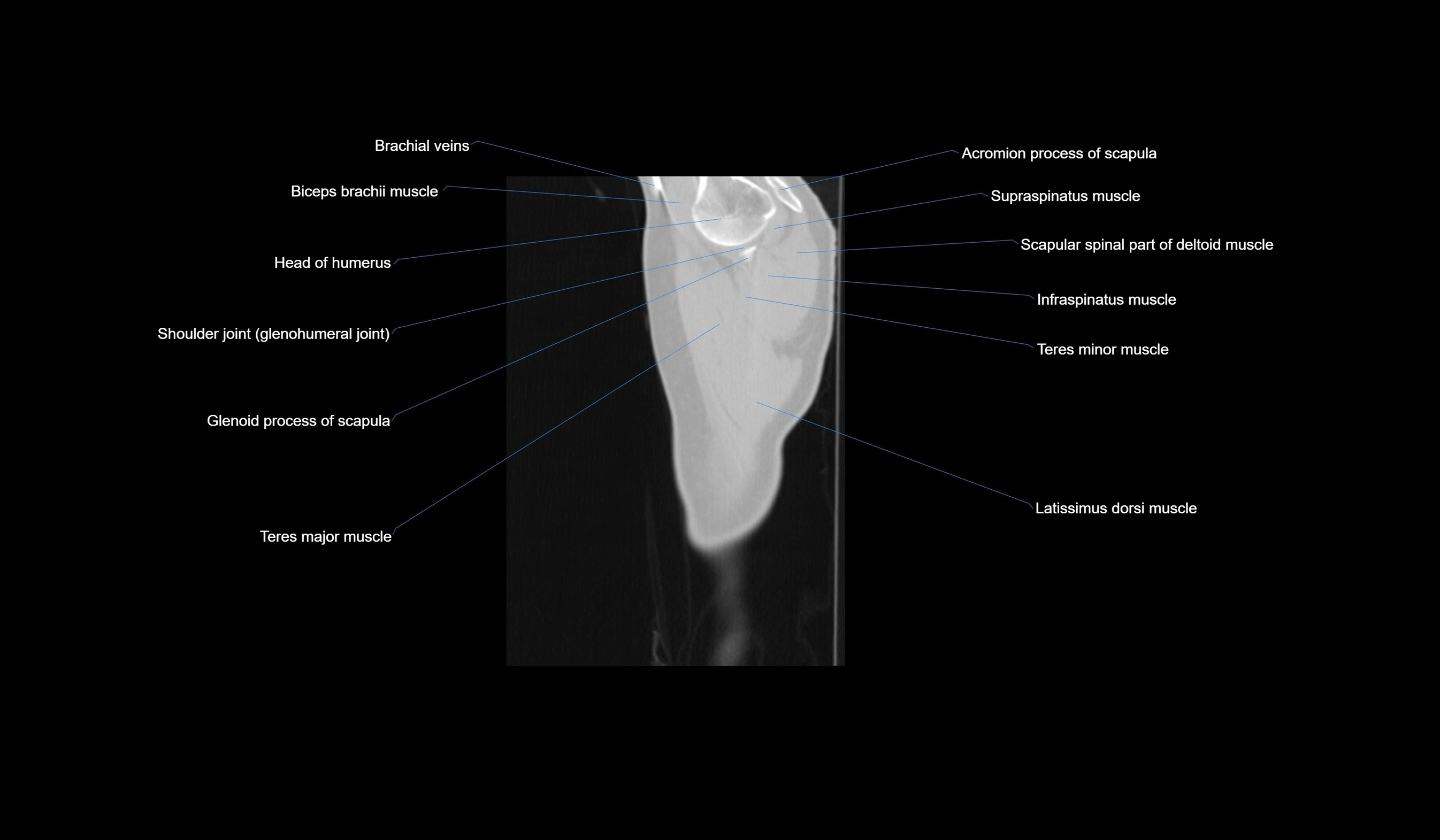 CT chest (thorax) lung window labelled sagittal cross sectional anatomy radiology image-00006.webp